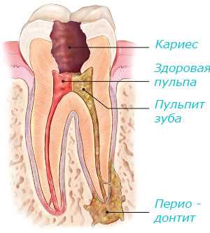 Болит зуб удаление