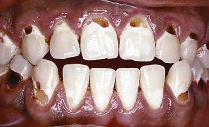 Нужно ли лечить молочные зубы и как их лечат?