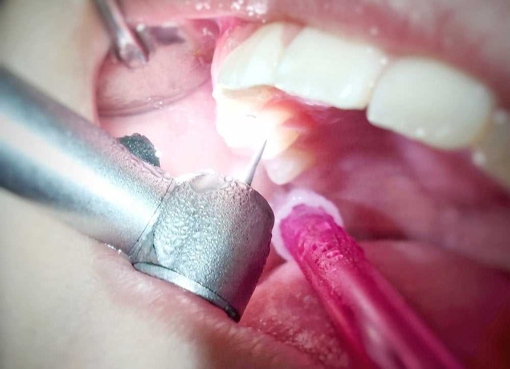 Основные виды местной анестезии в стоматологии: