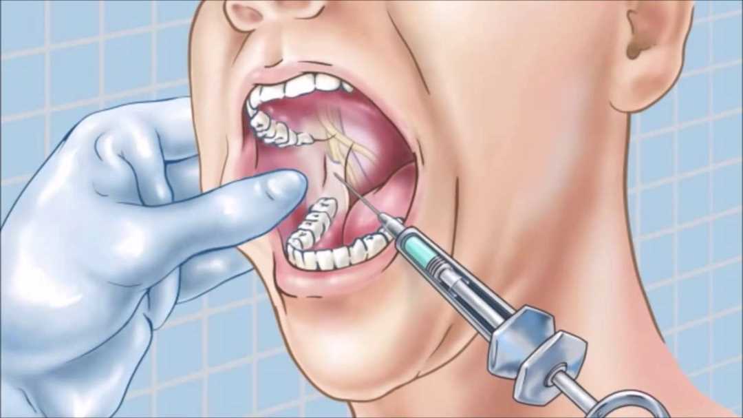 Какие препараты используют при анестезии у стоматолога?