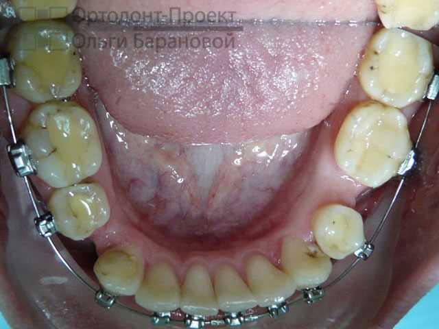 Брекеты после удаления зуба