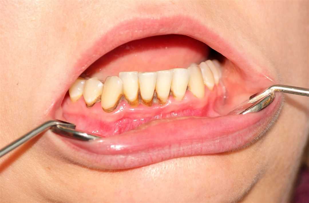 Профилактика образования твердого зубного налета