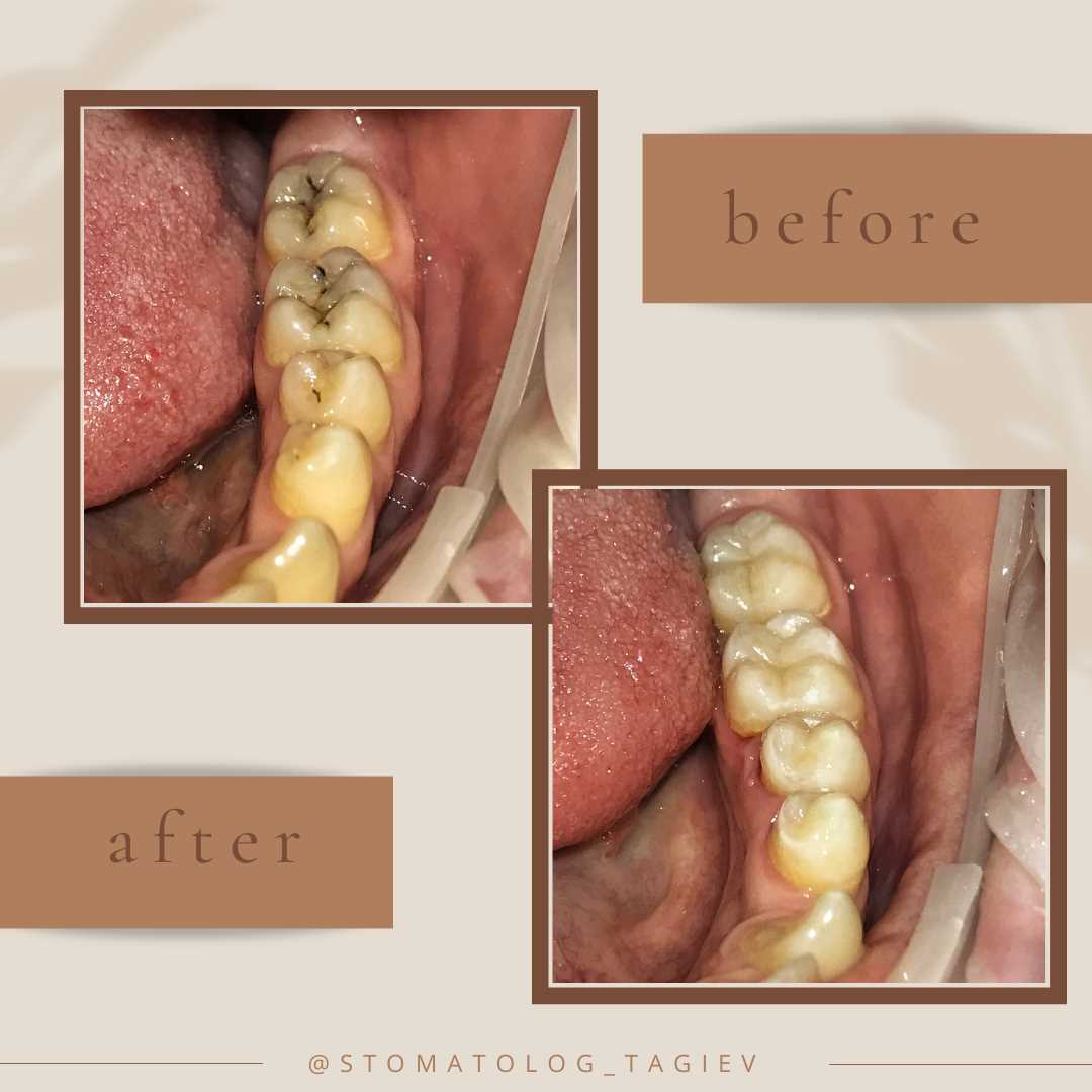 Чем пломба отличается от реставрации зуба