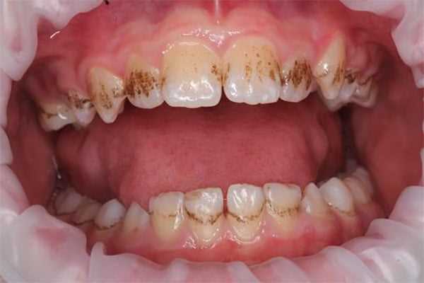 Причины образования темного зубного налета