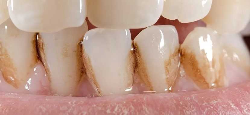 В чем состоит профилактика образования зубного налета