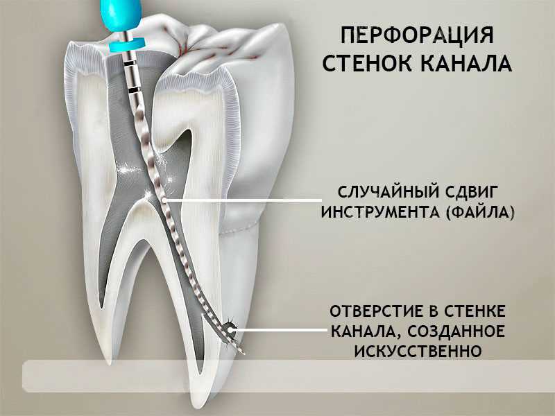 Чистка канала после удаления зуба