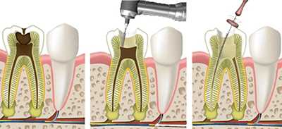 Чистка канала зуба и удаление нерва