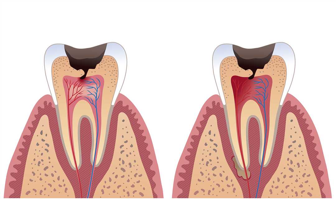 Комплексное лечение зубов и чистка каналов в профессиональной клинике