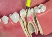 Чистка каналов зуба без анестезии