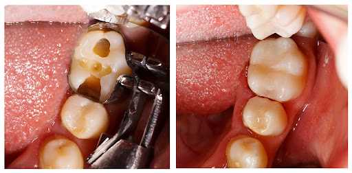 Чистка зубов после лечения кариеса