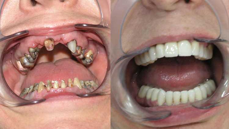 Какие виды зубных протезов существуют?