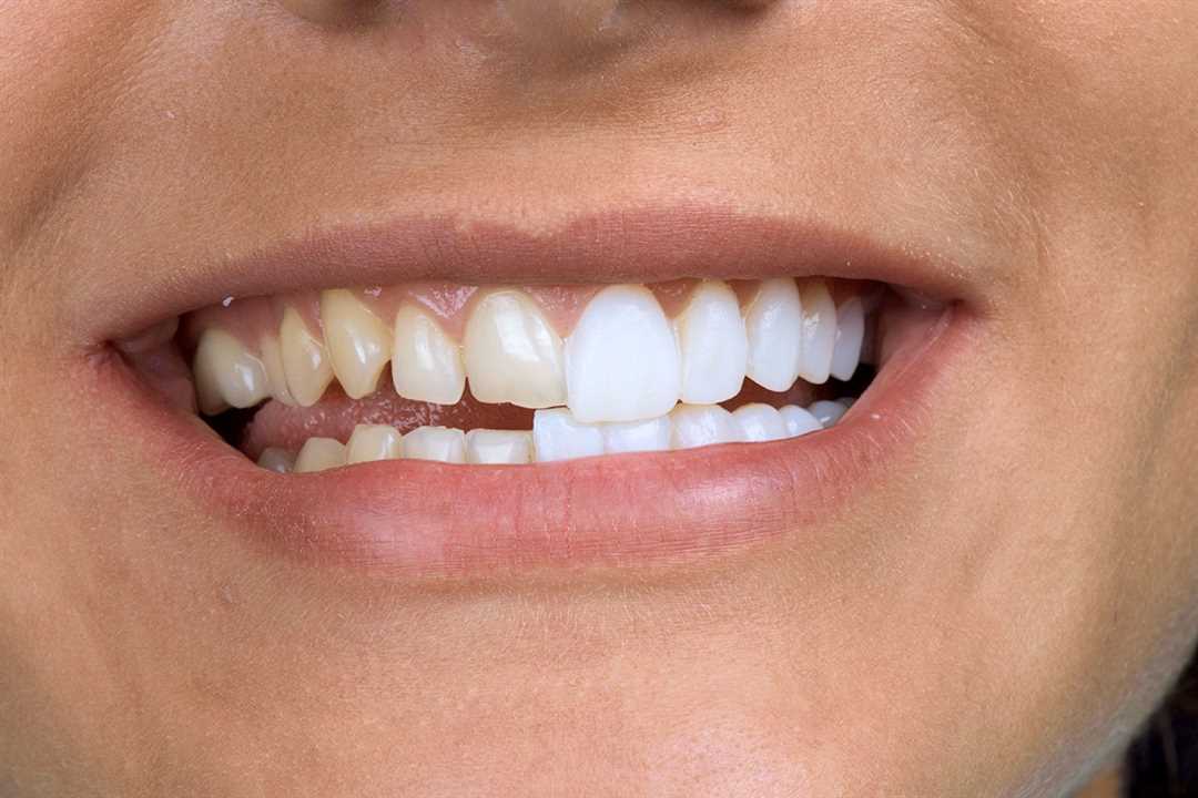 Что лучше виниры или реставрация зубов