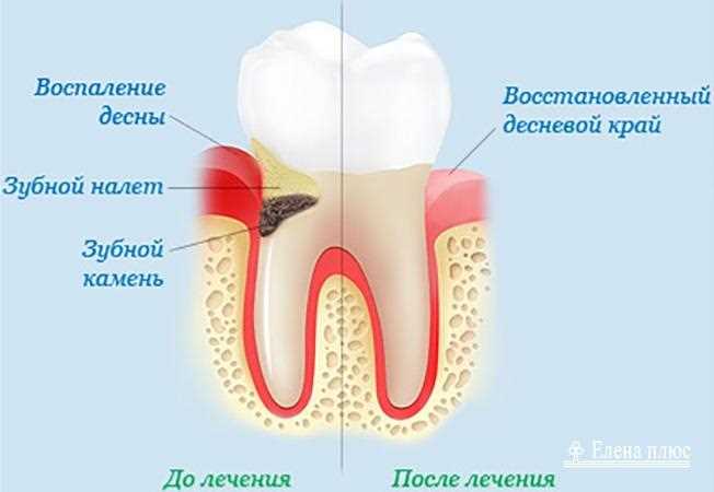 Чувствительность десны после удаления зуба