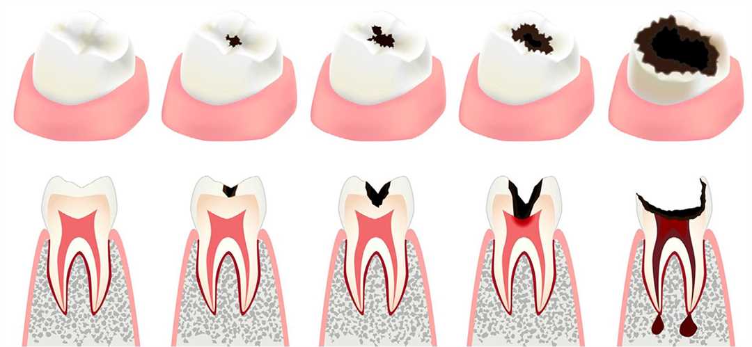 Повышенная чувствительность зуба после проведенного лечения кариеса