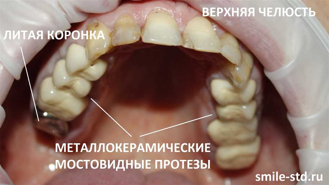 Дефекты зубных коронок