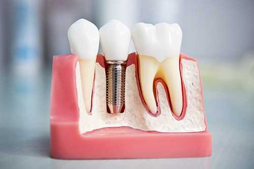 Дента протезирование зубов