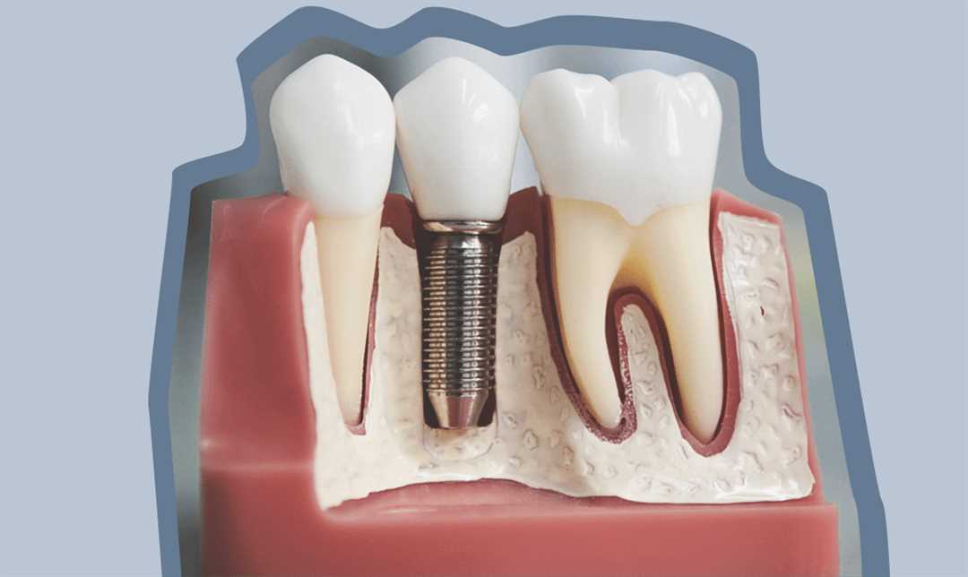 Дентальное протезирование зубов