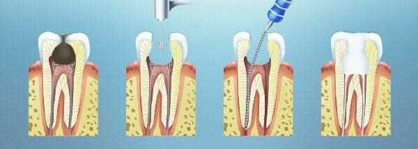 Депульпация зубов при протезировании