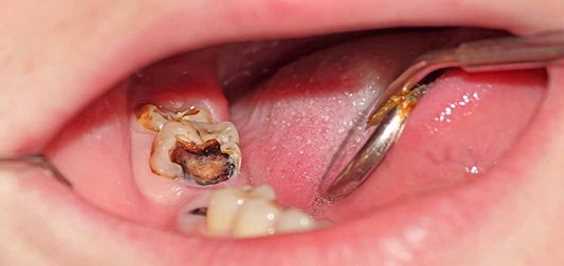 Этапы депульпирования зуба