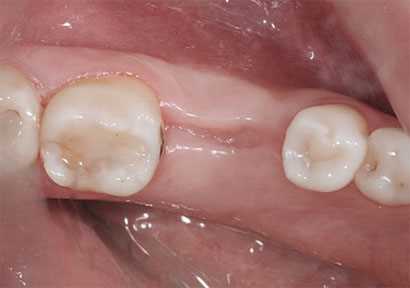 Сколько обычно заживают десны при удалении зубов