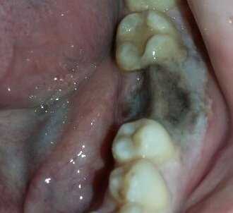 Десна после удаления зуба