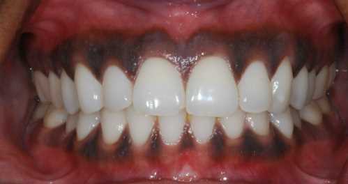 Потемнение зуба около десны - причины