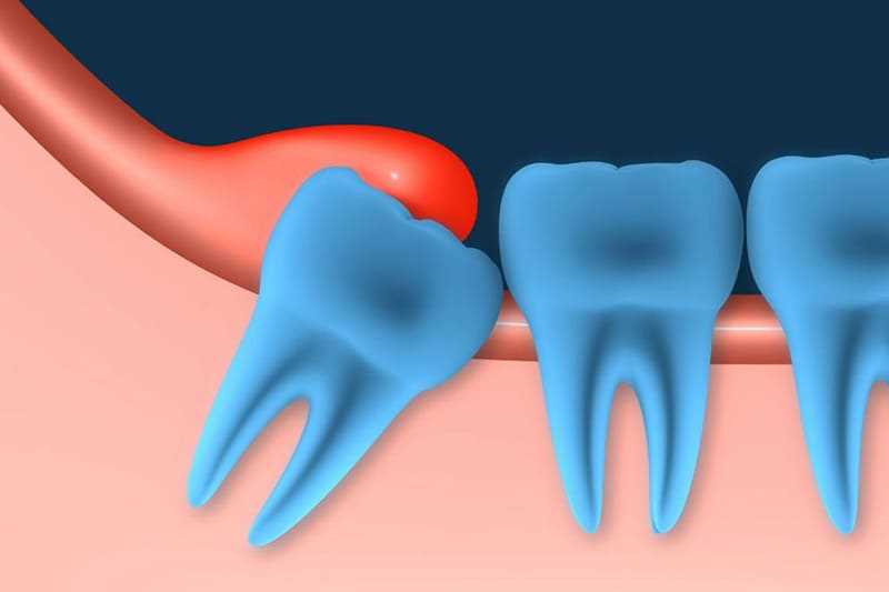 Десна зуб лечить удаление