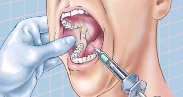 Самая эффективная анестезия в стоматологии