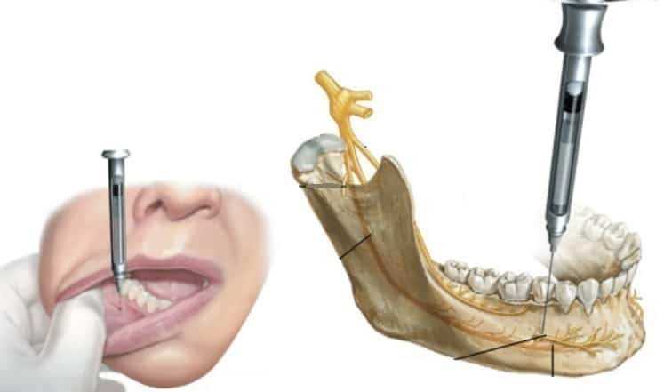 Какого зуба требуется анестезия?