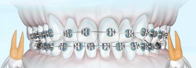Экспертиза протезирования зубов