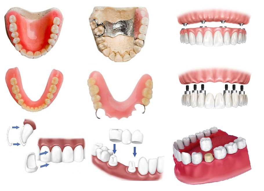 Эмалирование зубов — возможности и преимущества процедуры в стоматологии Подольска