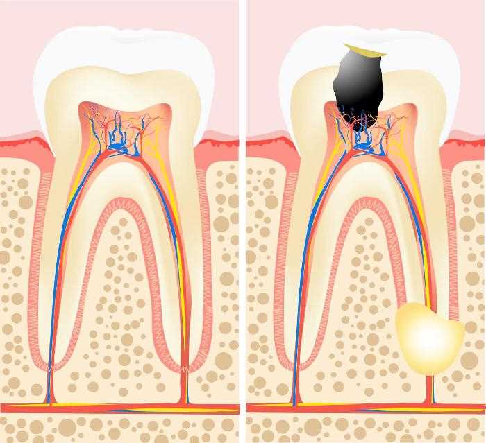 Особенности зубного пародонтита