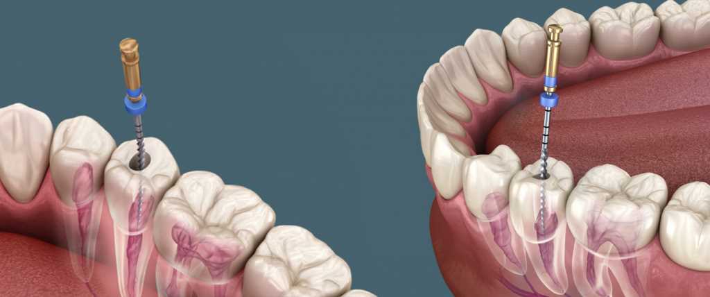 Эндодонтическое лечение корневых каналов зуба при помощи оптики включает в себя