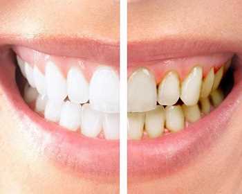 Симптомы эрозии зубов