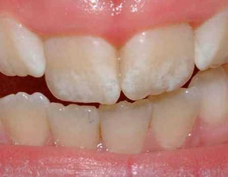 Эрозия зубной эмали. Причины и лечение