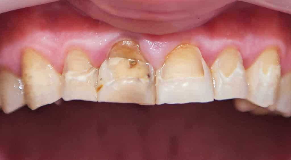 Диагностика эрозии зубов