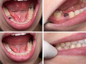 Как происходит протезирование зубов