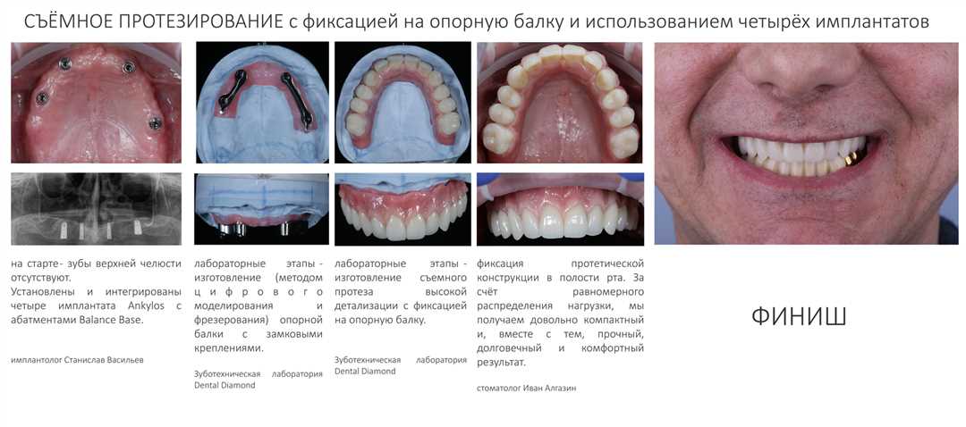 Этапы протезирования зубов на имплантах