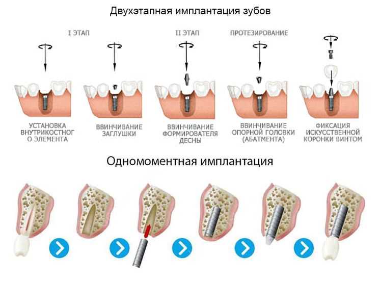 3. Снятие слепков, необходимых для работы зубных техников