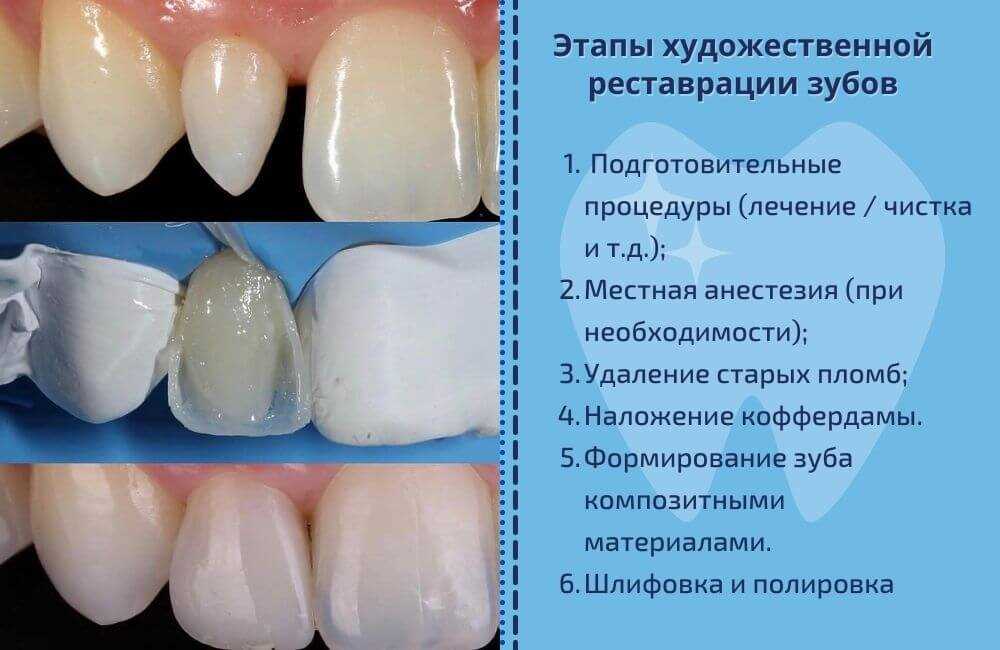 Композитное реставрационное отбеливание зубов