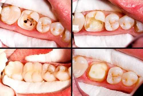 Этапы реставрации зубов — от диагностики и подготовки до финального шлифования и полировки