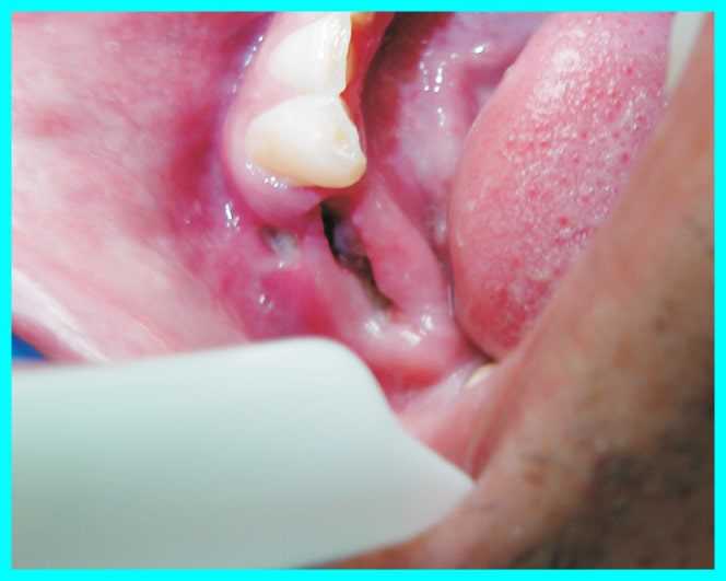 Процесс осложнения заживления после удаления зуба и важность применения флюса