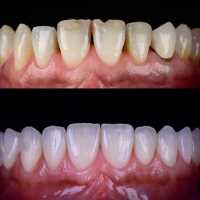 Какая формула используется при создании керамической зубной коронки для идеальной эстетики и функциональности