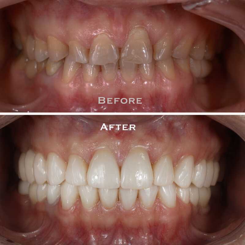 Функциональная реставрация зубов