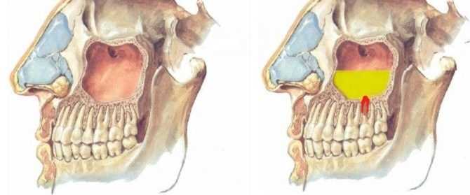 Последствия гайморита после удаления зуба — причины возникновения, симптомы и методы лечения