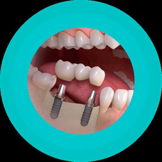 Имплантация зуба: возвращение улыбки и жизни
