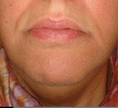 Симптомы гематом в полости рта