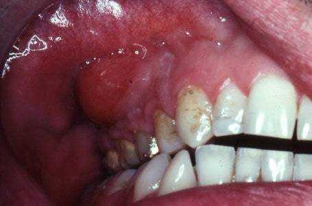 Причины образования гематом на слизистой полости рта