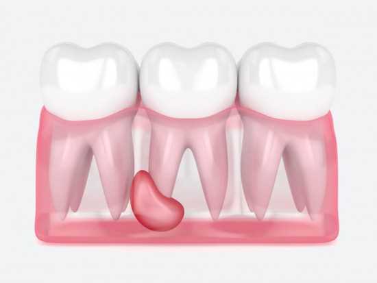 Гнойный абсцесс зуба – причины возникновения
