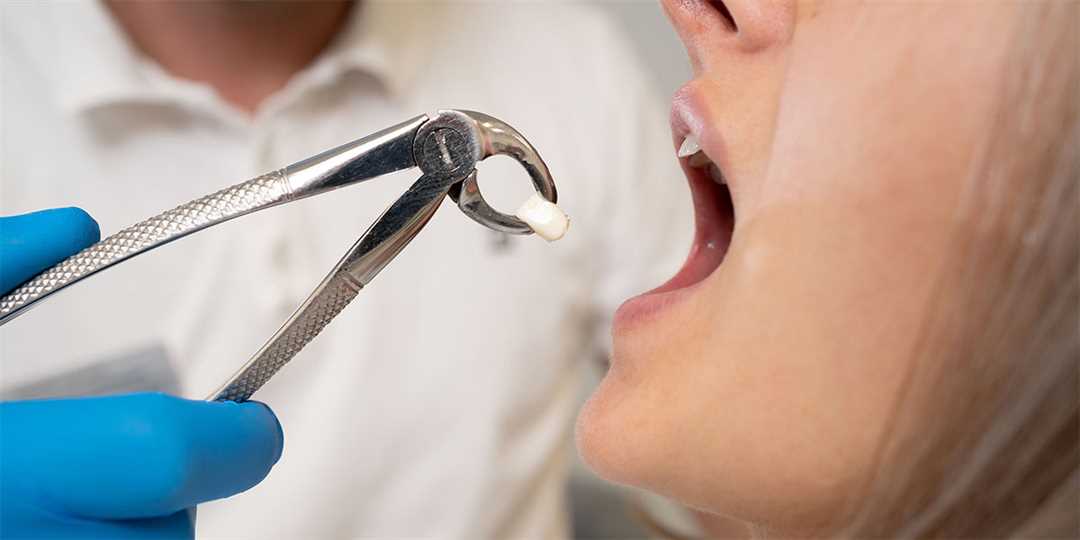 Почему после удаления зуба болит горло, как связаны эти два процесса и как облегчить дискомфорт